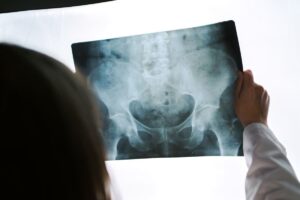 Médico observando una radiografía de cadera