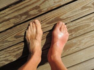 Plano cenital de dos pies, uno de los cuales está afectado por la enfermedad de gota
