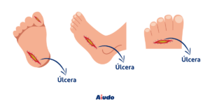 Infografía de úlceras en los pies