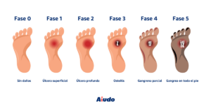 Infografía fases del pie diabético