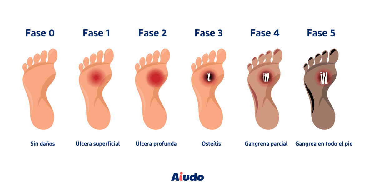 ¿cómo Tratar El Pie Diabético En El Adulto Mayor Aiudo Serviciosemk 6086