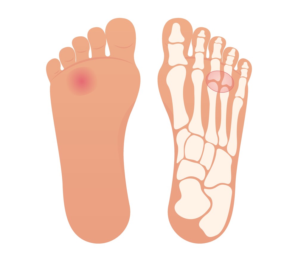 Gráfico de un pie afectado por el neuroma de Morton