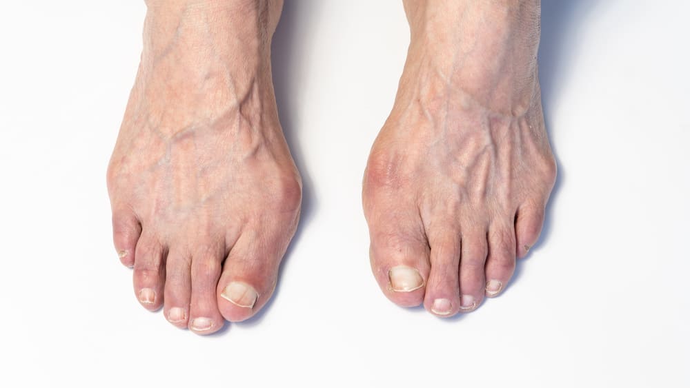 Dos pies de una persona mayor con un ligero juanete en el dedo gordo del pie derecho. 