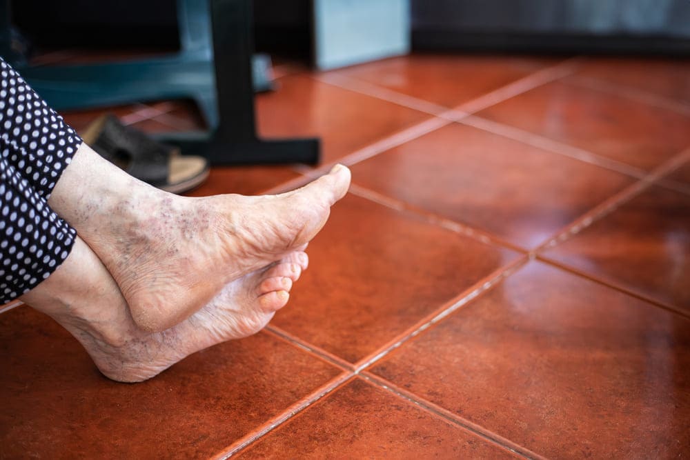 Unos pies cruzados de una señora mayor con una ligera desviación en el dedo gordo. 
