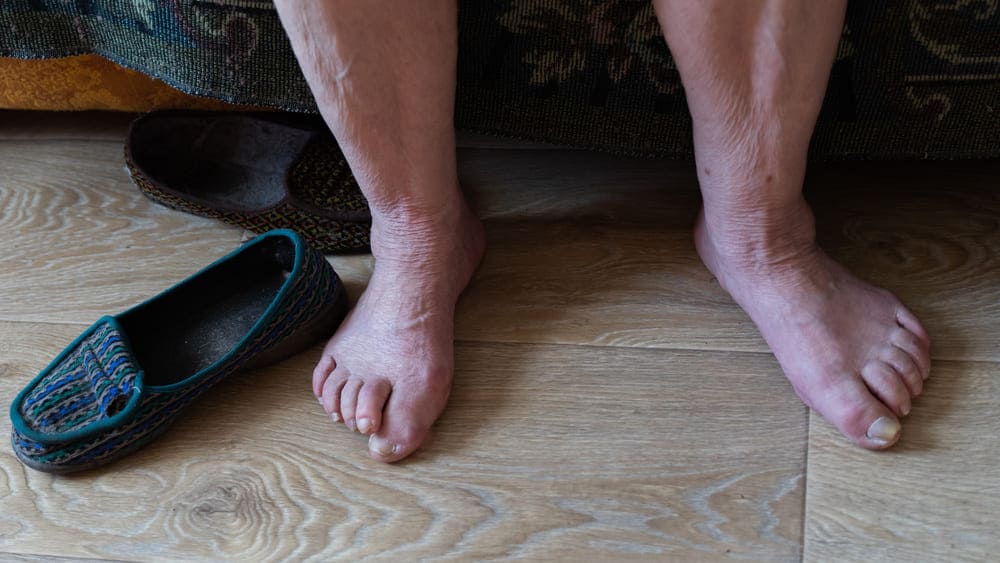 Un plano de las piernas y pies en martillo de una persona adulta mayor que está descalzo sobre el suelo de su casa. 